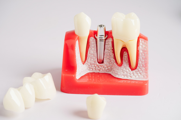 Dental implant, artificial tooth roots into jaw, root canal of dental treatment, gum disease, teeth model for dentist studying about dentistry.