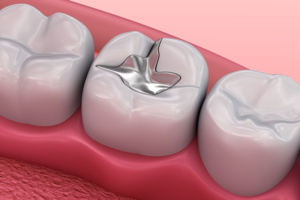 Metall dental fillings, Medically accurate 3D illustration