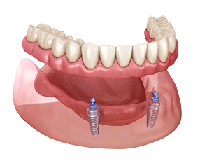 3D illustration of Mandibular removable prosthesis All on 2 system supported by implants with ball attachments