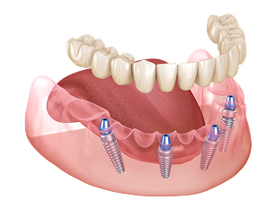 3D illustration of Mandibular prosthesis All on 4 system supported by implants