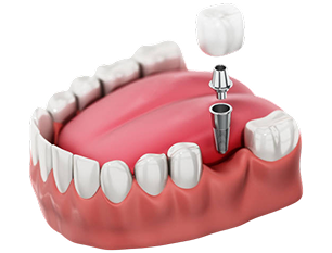 3D illustration of Tooth implant placed on lower jaw isolated on white.