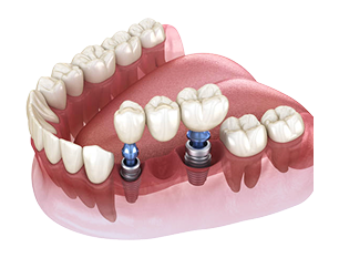 3D illustration of dental bridge supported by implants