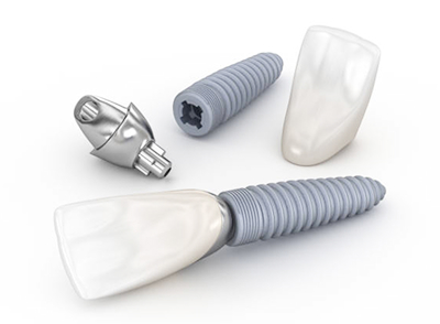 3D illustration of dental implantation