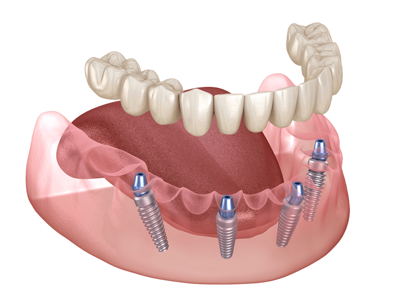 Mandibular prosthesis All on 4 system supported by implants