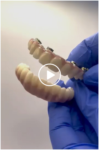 Zirconia Hybrid Full Arch Superstructure + Titanium Substructure + Soft Night Guard