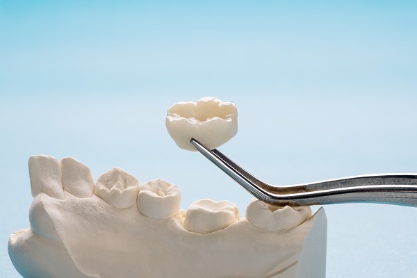 Closeup,/,Prosthodontics,Or,Prosthetic,/,Single,Teeth,Crown,And