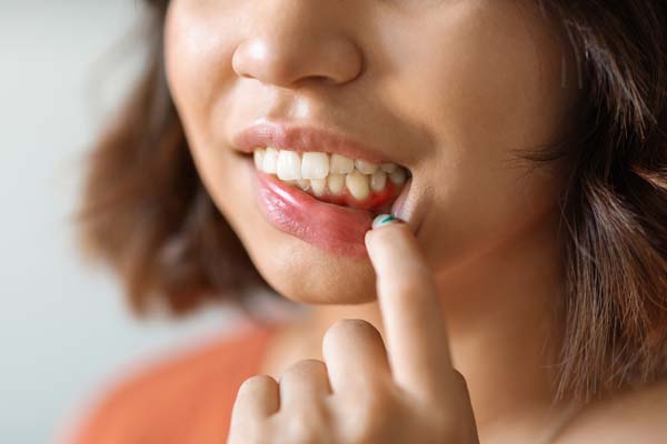Gingivitis Concept. Young Woman Pulling Her Lip And Demonstrating Irritated Gums, Unrecognizable Female Suffering Gingival Inflammation And Dental Problems, Closeup Shot, Cropped Image
