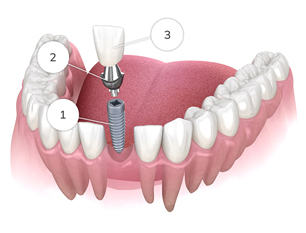single-implant-img