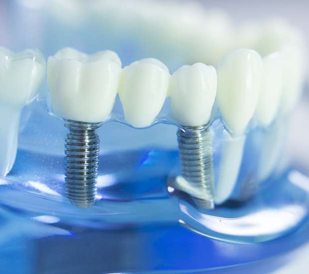 Salida Dental Implants