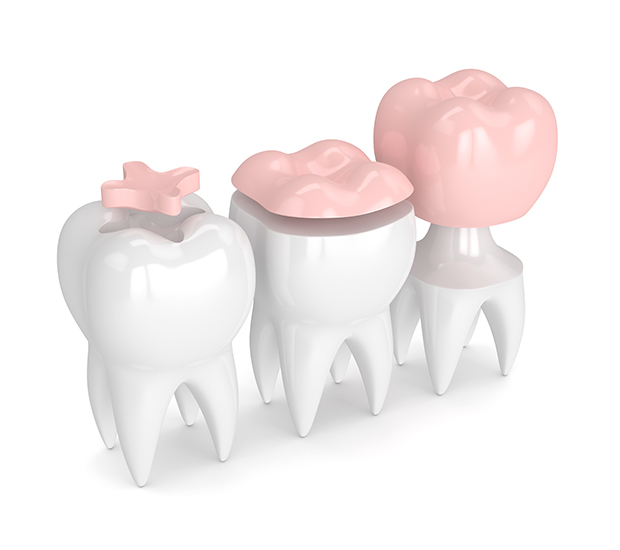 Salida Dental Inlays and Onlays