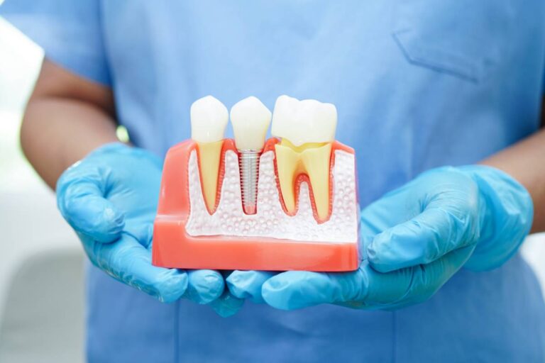 Featured image for How Long Do Dental Implants Last?